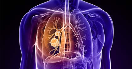 جراحة أورام الرئة
