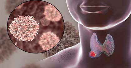 جراحة أورام الغدة الدرقية