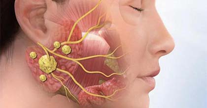 جراحة أورام الغدة النكافية والغدد اللعابية