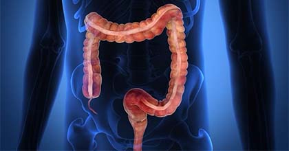 جراحة أورام القولون والمستقيم