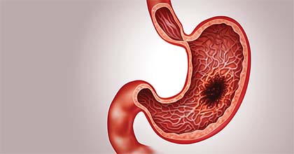 جراحة أورام المعدة والمرئ