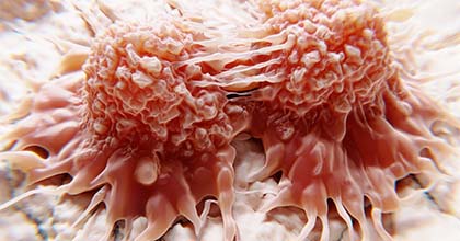 جراحة ساركوما الأنسجة الرخوة