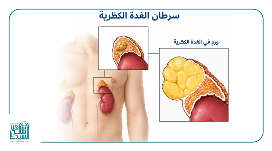 اورام الغدة الكظرية
